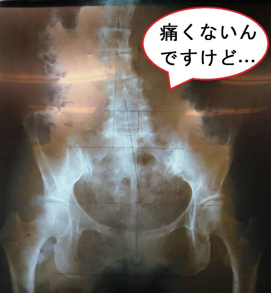 背骨骨盤のレントゲン画像